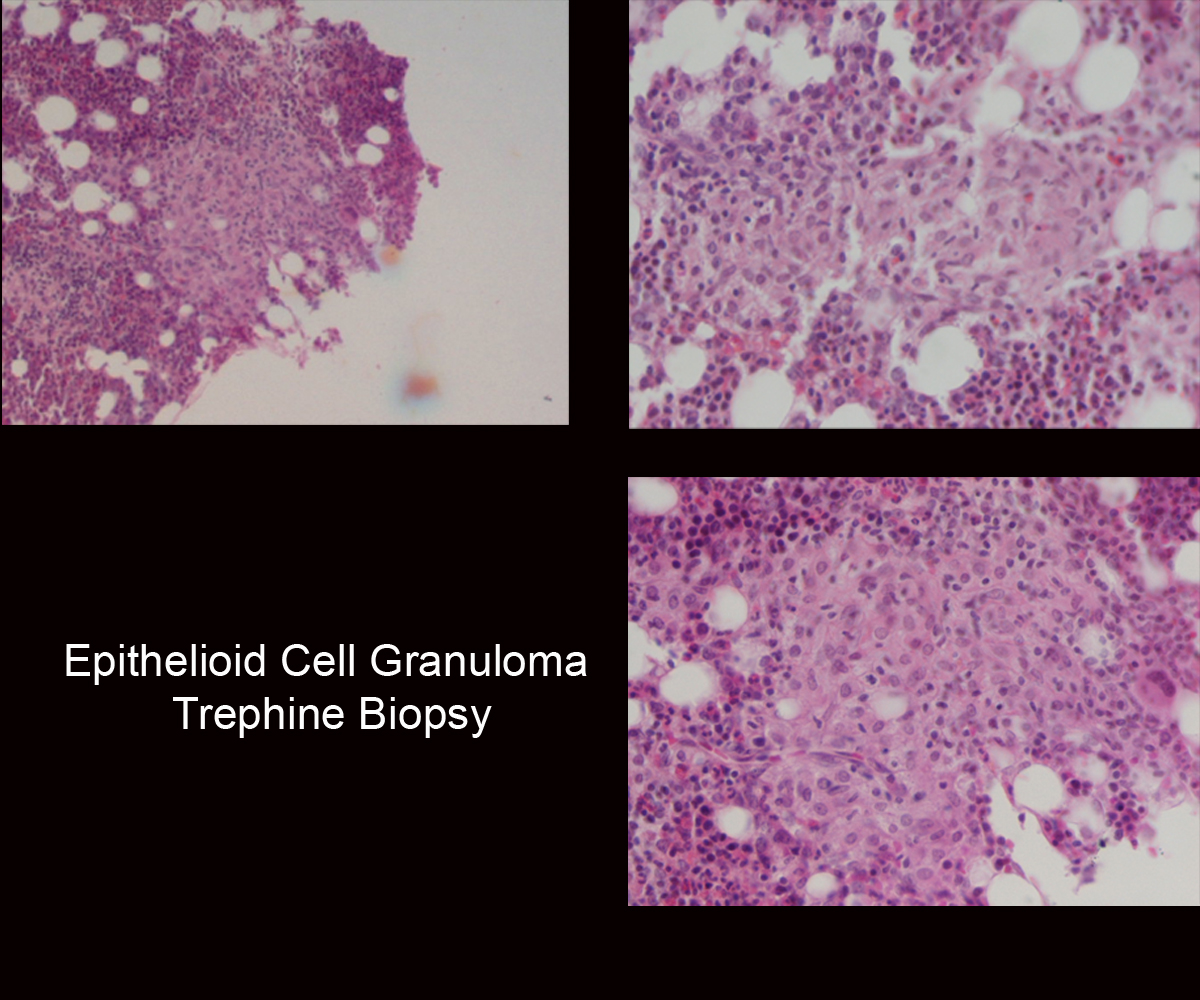 40.Epithelioid_Cell_Granuloma_Trephine_Biopsy.jpg