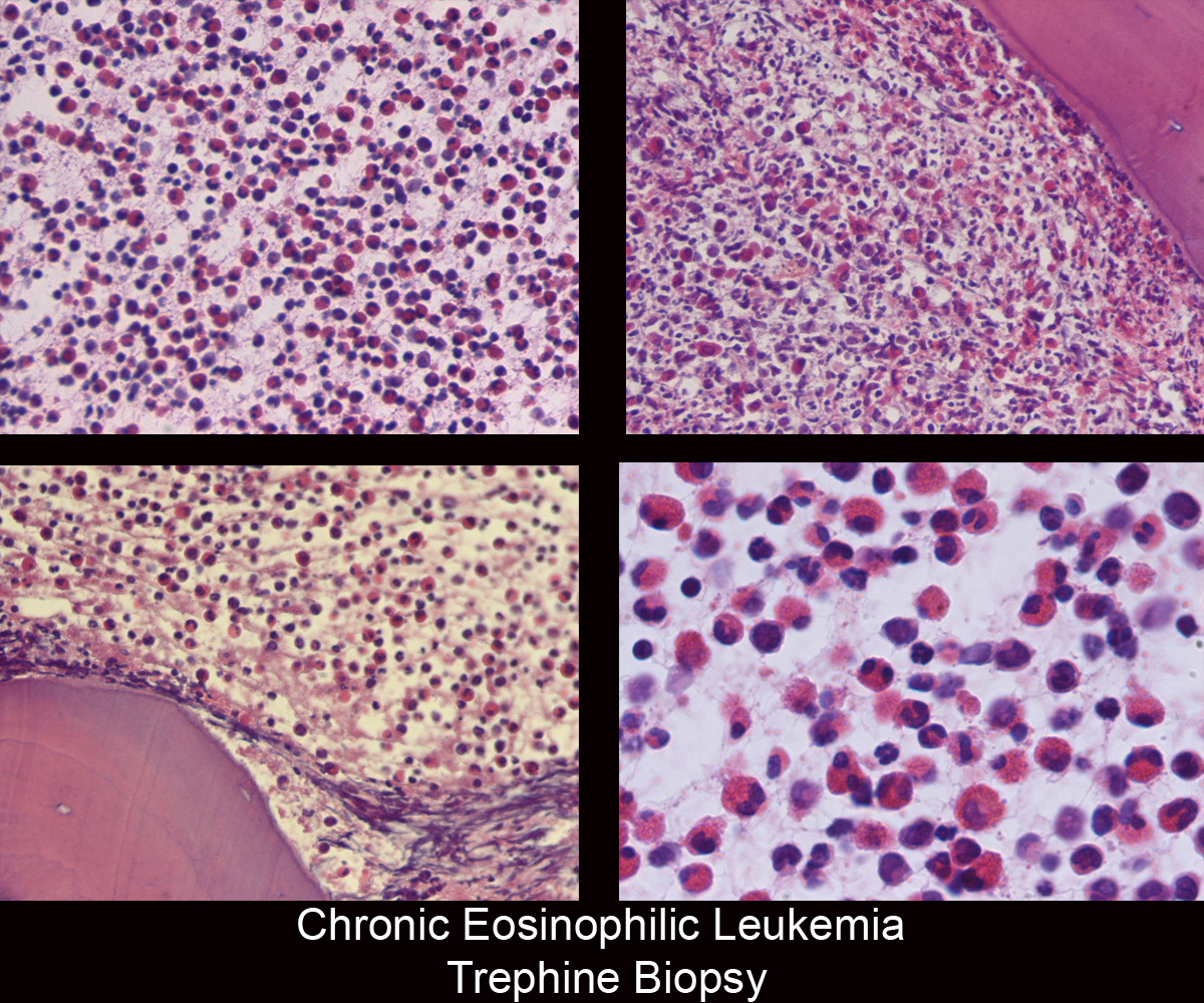 41.Chronic_Eosinophilic_Leukemia_Trephine_Biopsy.jpg