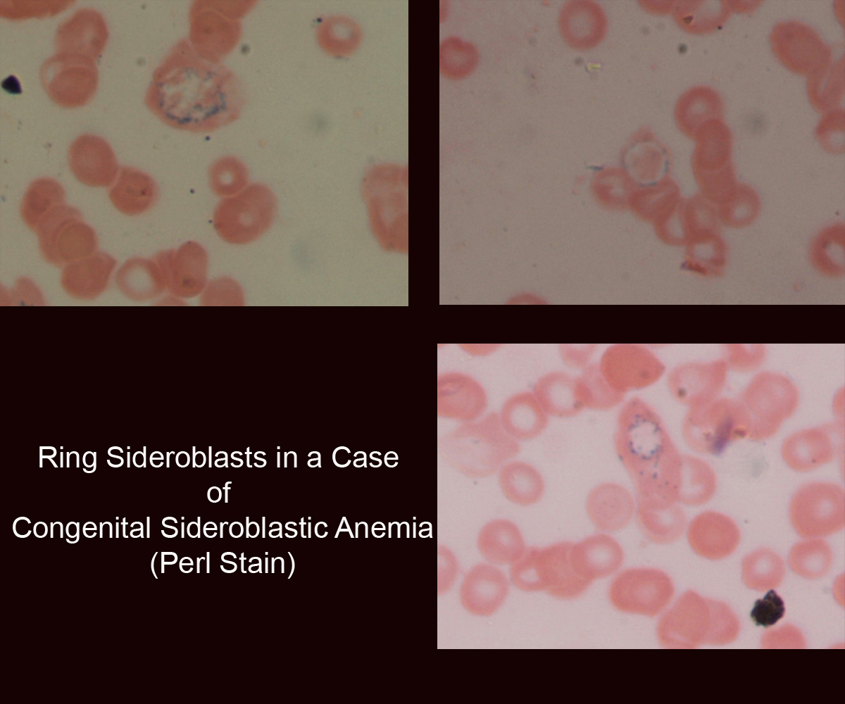 42._Ring_Sideroblasts_in_a_case_of_Congenital_Sideroblastic_Anemia.jpg