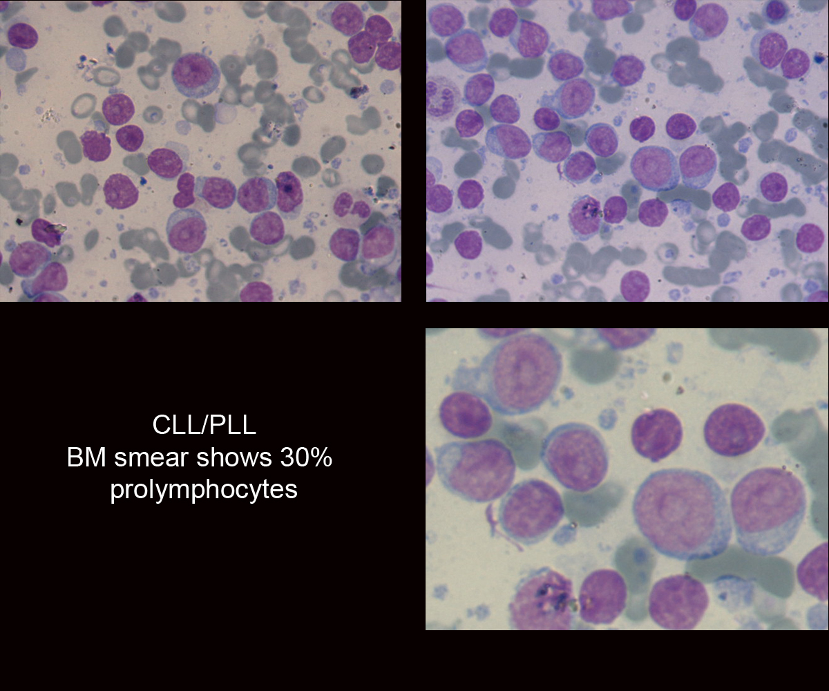 CLL_PLL_BM_smear_shows_30_prolymphocytes_copy.jpg