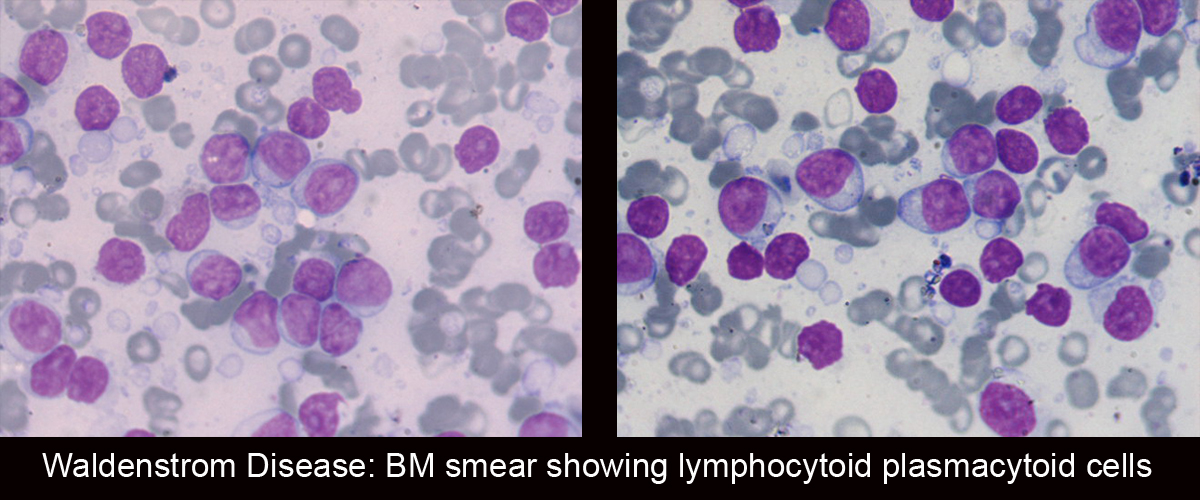 Waldenstrom_Disease_BM_smear_showing_lymphocytoid_plasmacytoid_cells.jpg